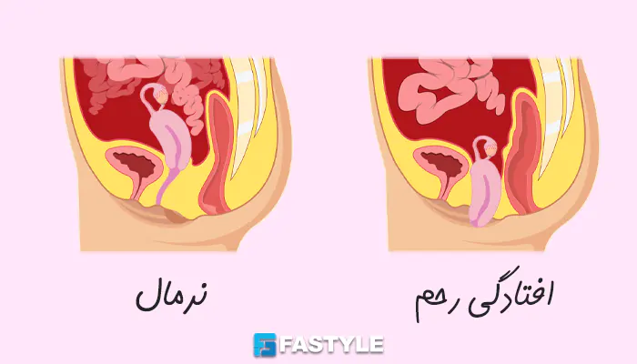 تفاوت رحم سالم با افتادگی رحم